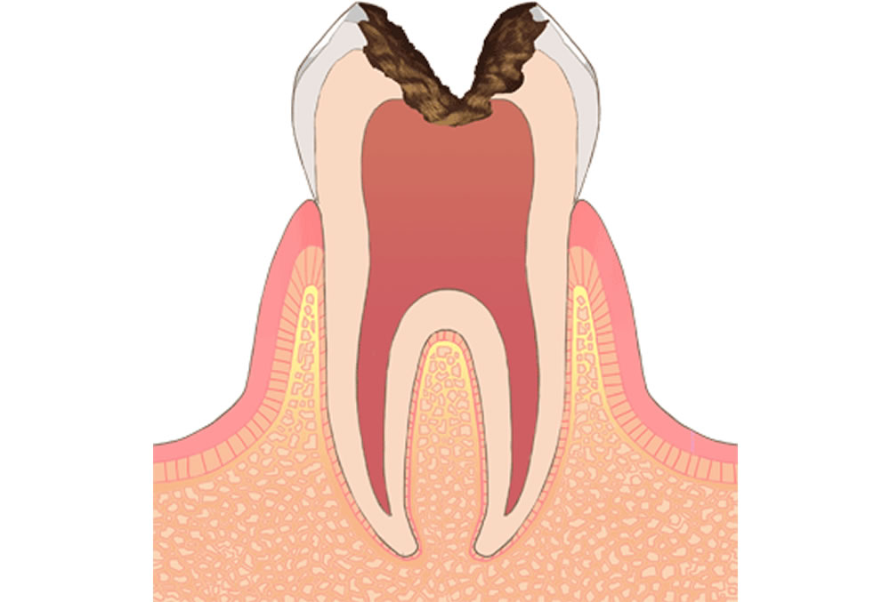 歯髄(神経)に達した虫歯