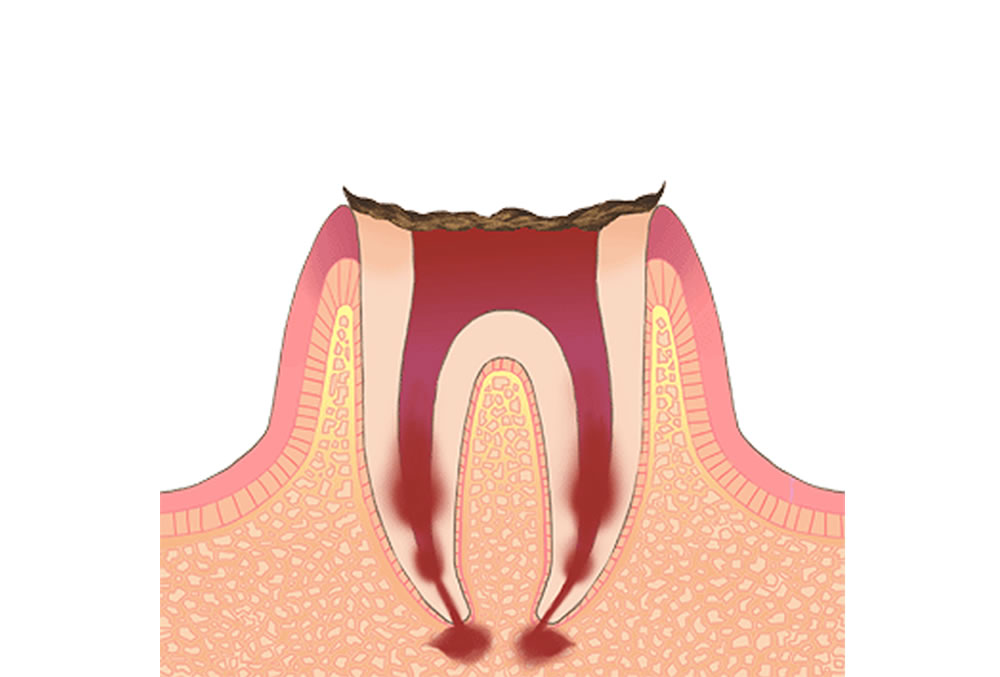 歯の根だけが残っている歯
