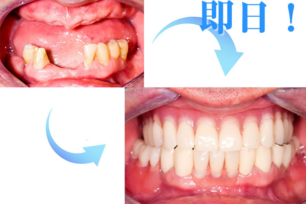 即時埋入インプラント